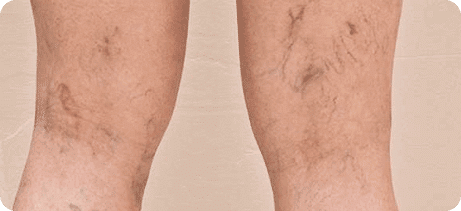 Síntomas de varices